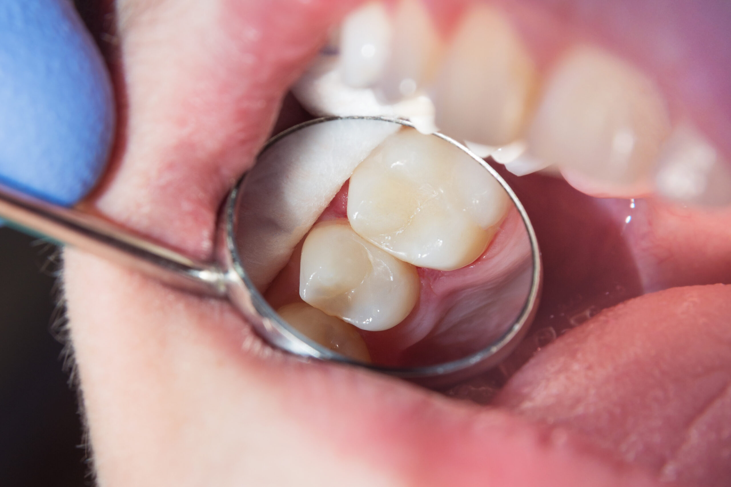 White Fillings