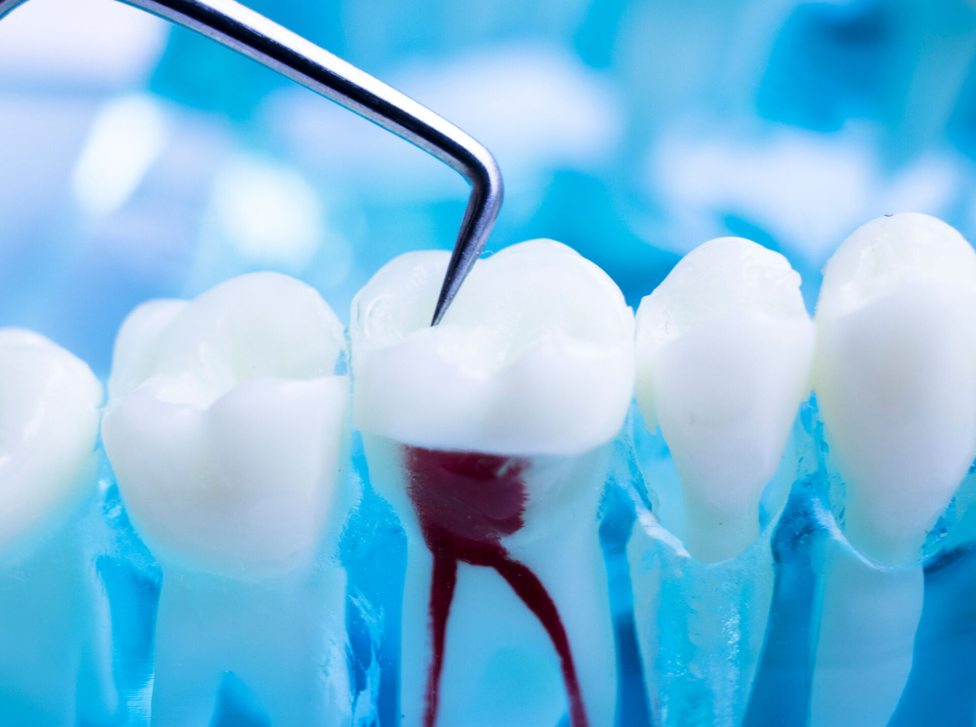 Root Canal Treatment