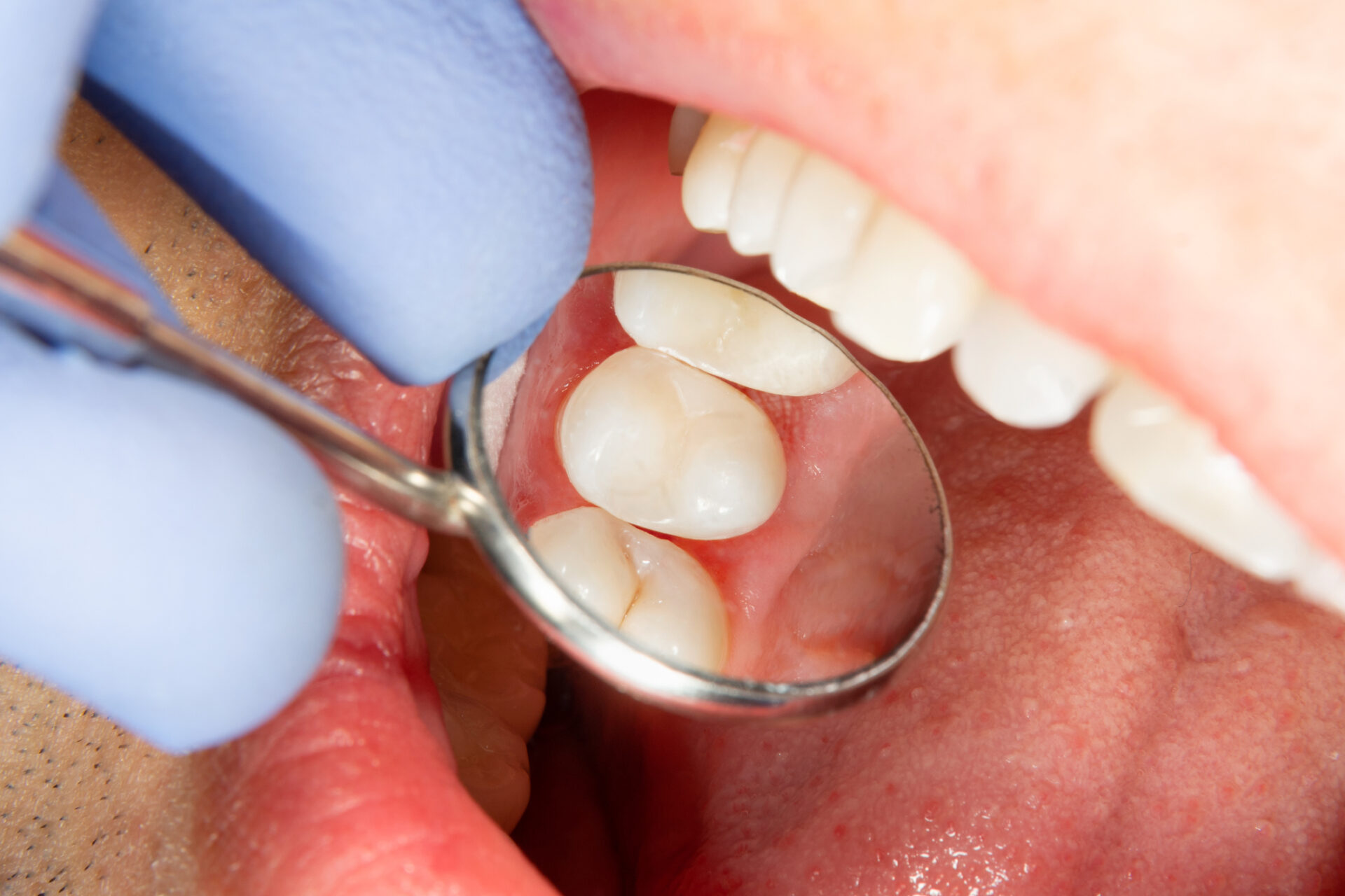 White Fillings