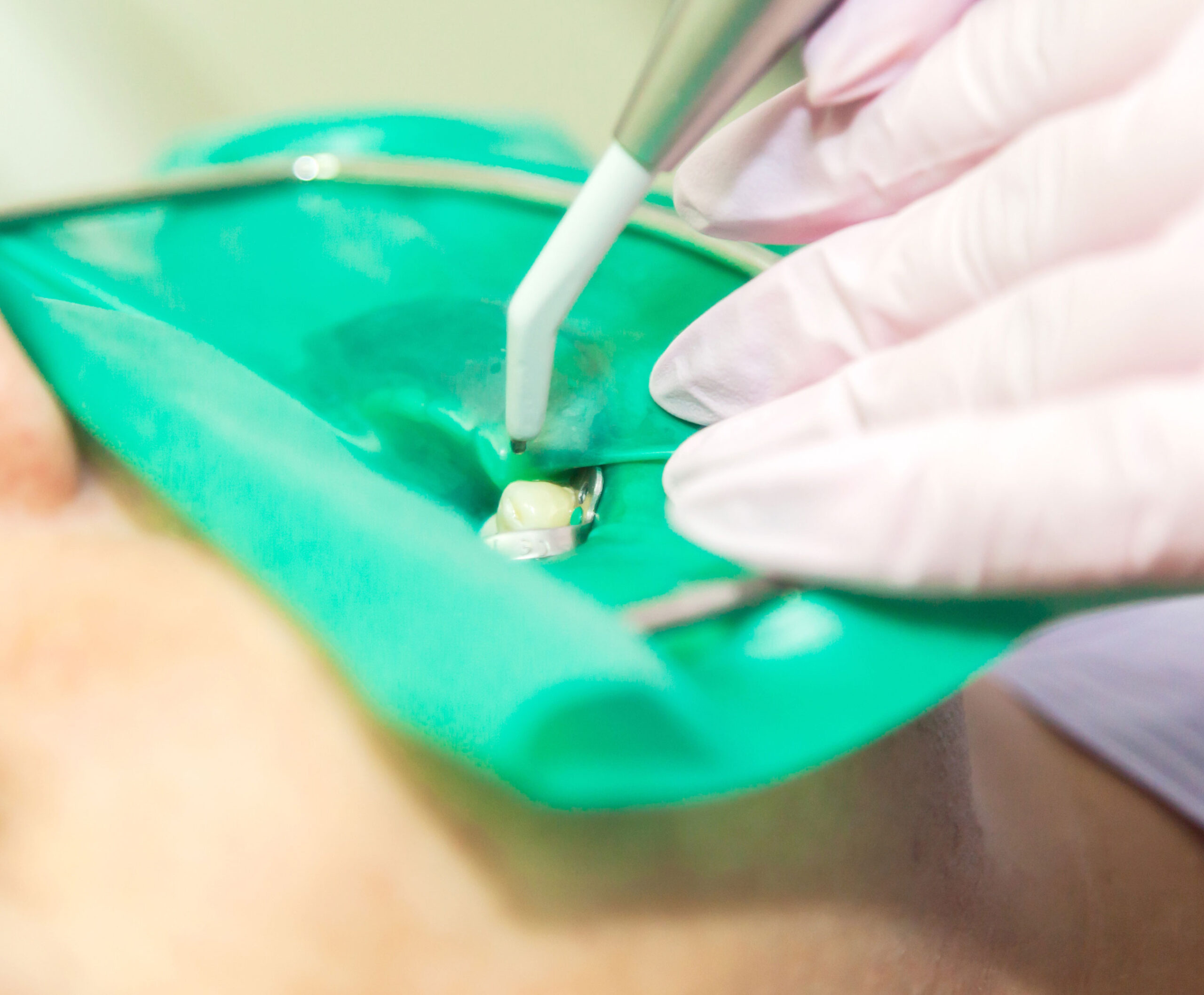 Root Canal Treatment